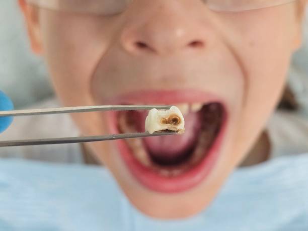 Best Cracked Tooth Emergency Dentist  in Cresaptown, MD